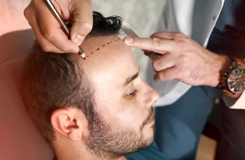 Matus šodien, nevis rīt: spēcīgie līdzekļi pret matu zudumu